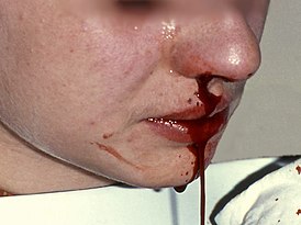 Epistaxis1.jpg