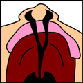 Cleftpalate2.png