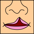 CleftLip1.svg