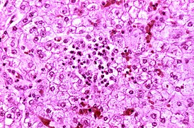 Reye's syndrome liver-histology.jpg