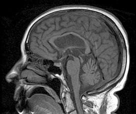 Steele-olszewski-richardson disease.jpg