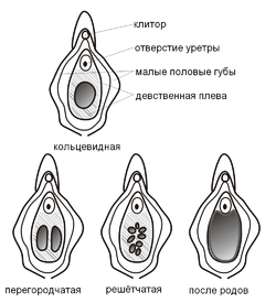 Типы строения девственной плевы человека