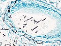 Pulmonary angioinvasive aspergillosis.jpg