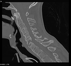 Ankylosing spondylitis.jpg