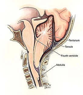 Chiari2.jpg