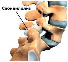 3D модель спондилолиза